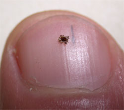 Deer ticks are tiny, it's not hard to miss one