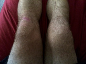 Swelling in the right knee.